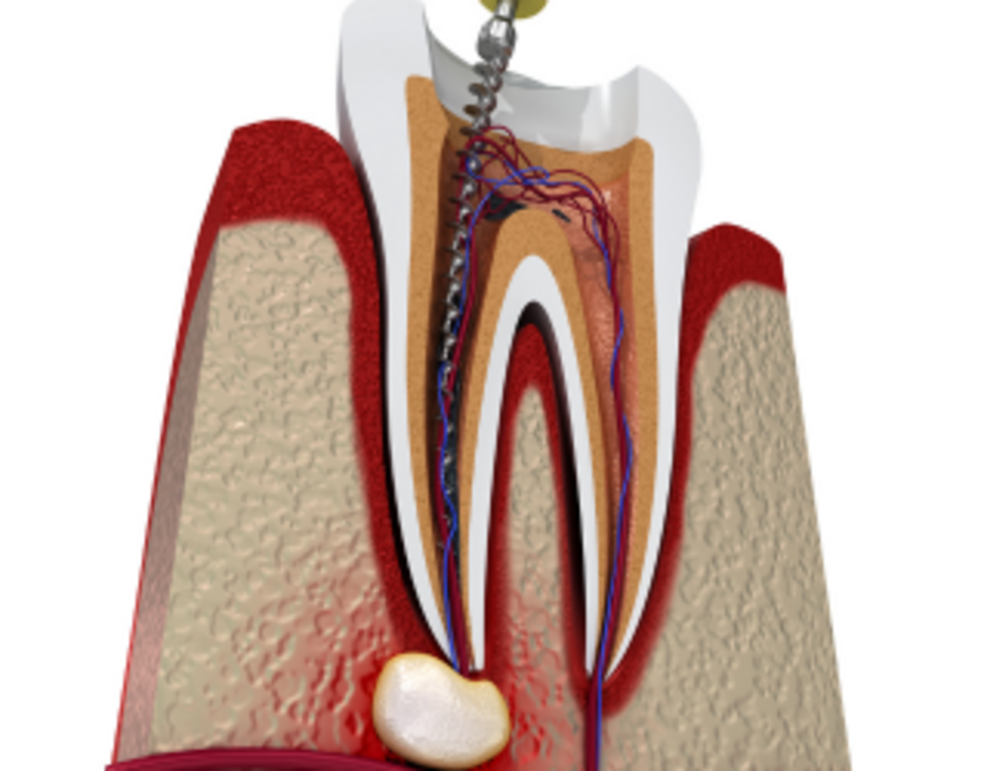 Root Canal Therapy